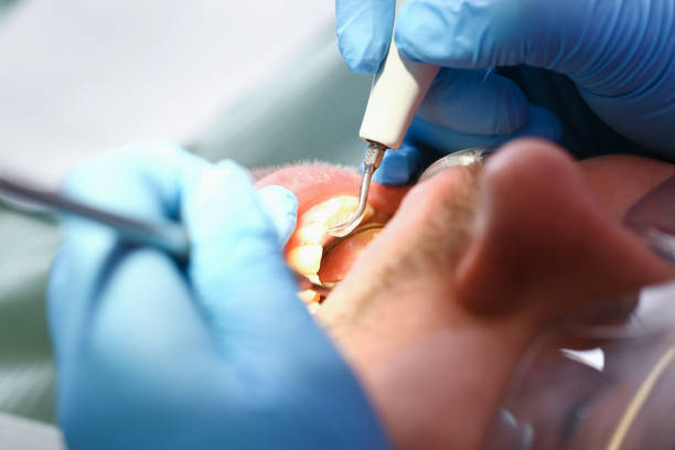 Best Emergency Treatment for Dental Infections or Abscesses in Buena Vista, GA